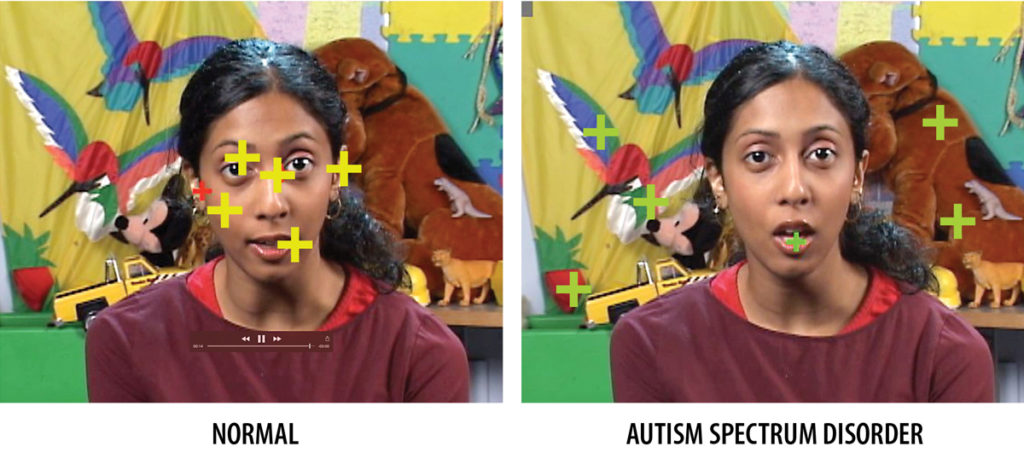 Eye tracking: The way young children explore the world with their eyes is under strict genetic control. When comparing the viewing habits of kids, patterns emerge. Bottom left, as illustrated by the crosshairs, normally developing children typically focus on people’s faces, particularly eyes and mouths. In atypical development, children fixate on inanimate objects. Identifying this lack of social engagement is a useful tool in early diagnosis.